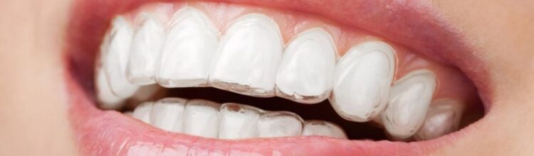 2021-04-Dental-Arca-Ortodonzia-Invisibile-Mascherine-Trasparenti-Smile-Concept