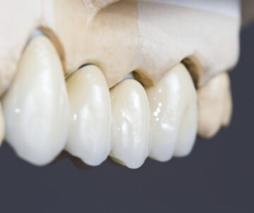 Ceramiche dentali