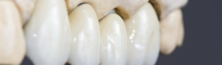 Ceramiche dentali