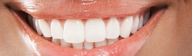 denti ingialliti