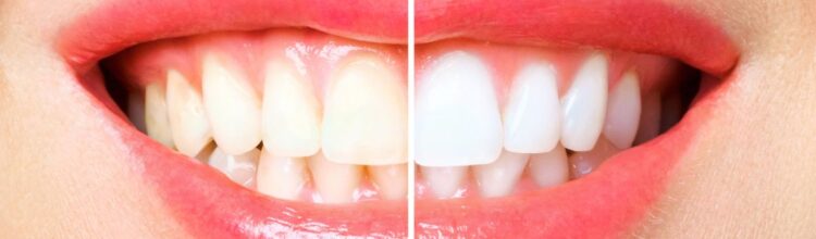 denti più bianchi
